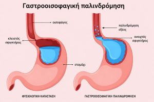 Γαστροοισοφαγική παλινδρόμηση: ιατρικό διάγραμμα που απεικονίζει τη φυσιολογική λειτουργία του κατώτερου οισοφαγικού σφιγκτήρα σε σύγκριση με την παλινδρόμηση γαστρικού οξέος από το στομάχι προς τον οισοφάγο.